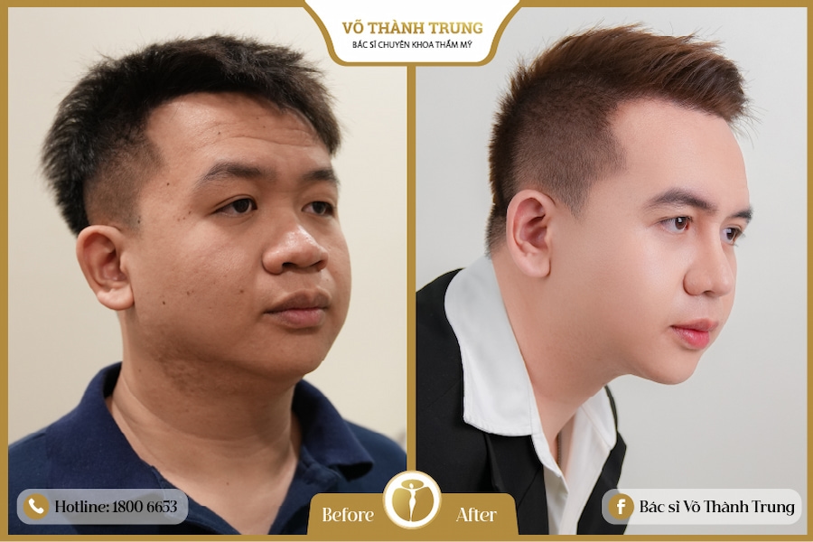 khách hàng nam sau khi nâng mũi hàn quốc