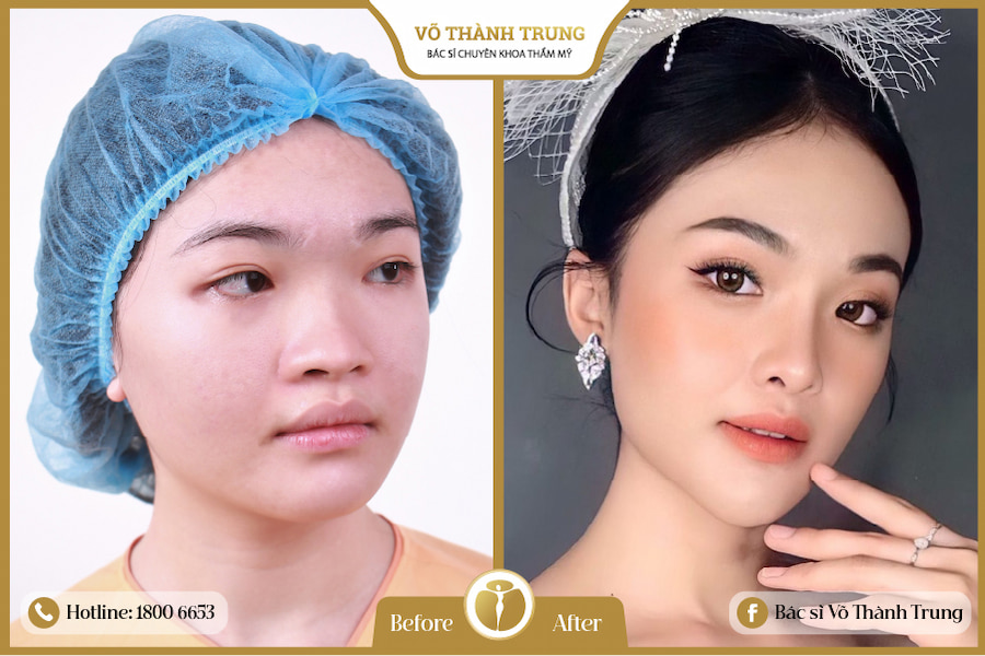 khách hàng nâng mũi Hàn Quốc