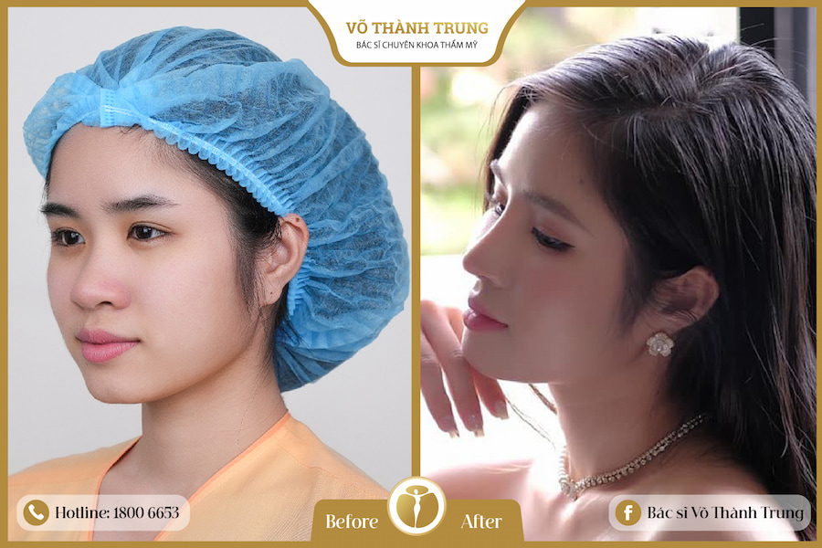 phương pháp nâng mũi Mega S