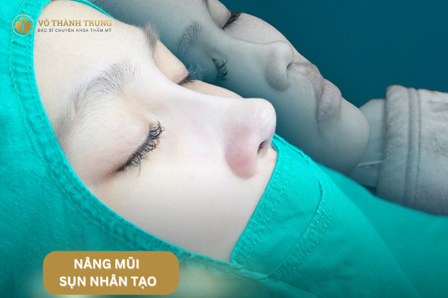 Nâng mũi sụn nhân tạo là phương pháp nâng mũi sử dụng sụn nhân tạo để định hình và nâng cao sống mũi Nâng mũi sụn nhân tạo là phương pháp nâng mũi sử dụng sụn nhân tạo để định hình và nâng cao sống mũi