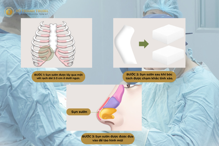 Sụn tự thân nâng mũi được lấy từ chính cơ thể khách hàng Sụn tự thân nâng mũi được lấy từ chính cơ thể khách hàng