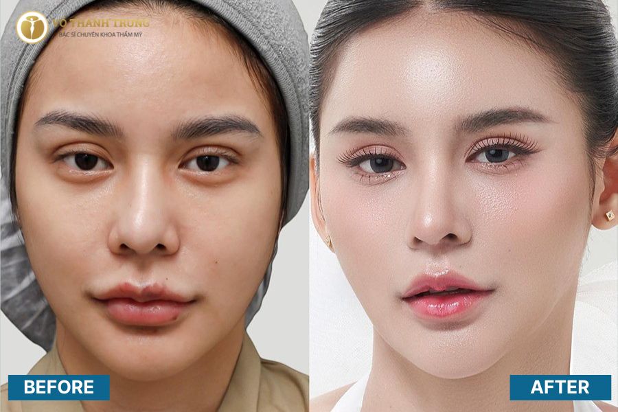 Quyết định có nên nâng mũi cao tây hay không phụ thuộc vào nhu cầu thẩm mỹ của từng người Quyết định có nên nâng mũi cao tây hay không phụ thuộc vào nhu cầu thẩm mỹ của từng người