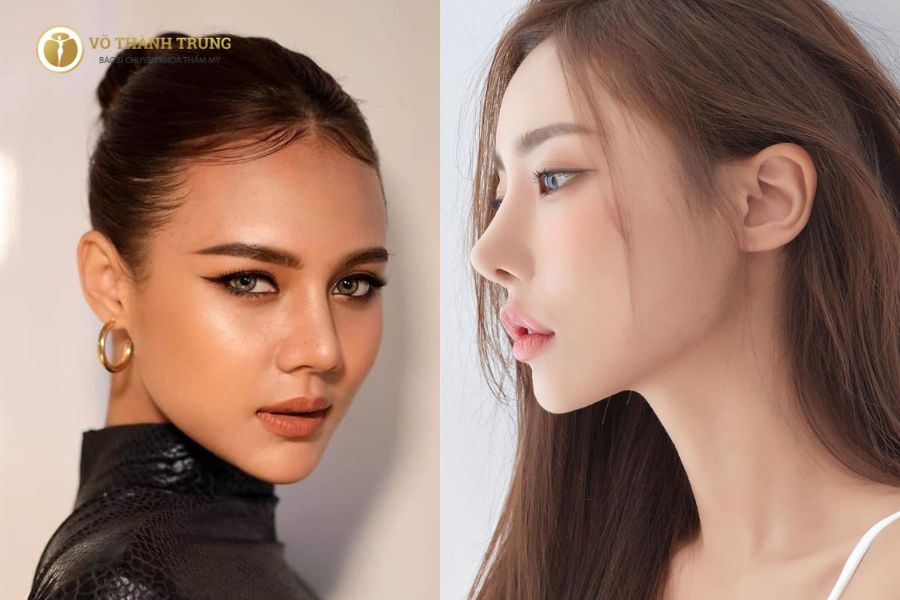 Nâng mũi cao Tây là phương pháp thẩm mỹ tạo hình dáng mũi với sống mũi cao thẳng, đầu mũi gọn, mang đậm nét đặc trưng của người châu Âu Nâng mũi cao Tây là phương pháp thẩm mỹ tạo hình dáng mũi với sống mũi cao thẳng, đầu mũi gọn, mang đậm nét đặc trưng của người châu Âu