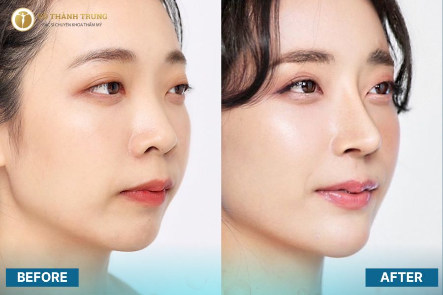 Nâng mũi L Line cao tây giúp tạo ra dáng mũi thẳng tắp, tạo hình sống mũi rõ nét và đẹp tự nhiên Nâng mũi L Line cao tây giúp tạo ra dáng mũi thẳng tắp, tạo hình sống mũi rõ nét và đẹp tự nhiên