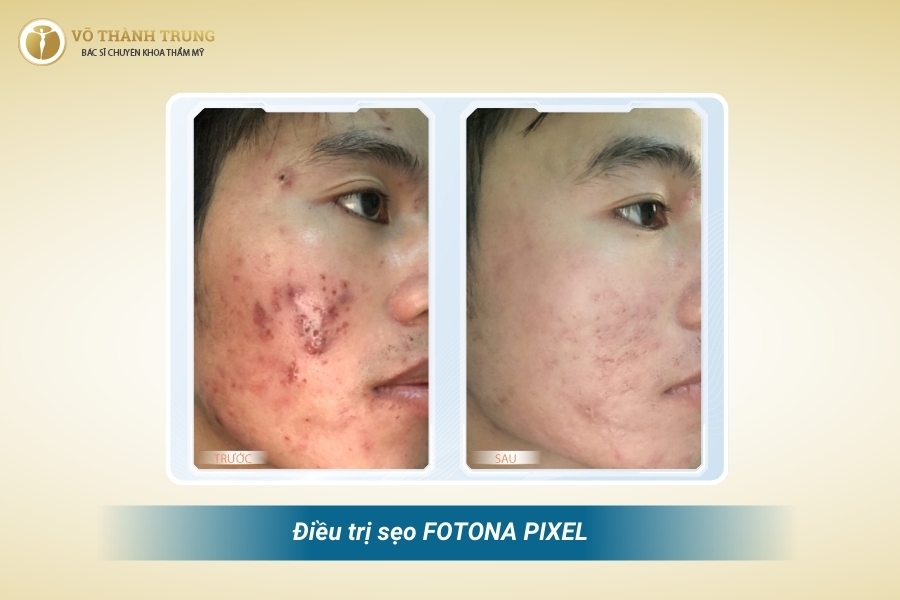 FOTONA PIXEL giúp tái tạo toàn bộ bề mặt da, đem lại diện mạo làn da mới FOTONA PIXEL giúp tái tạo toàn bộ bề mặt da, đem lại diện mạo làn da mới