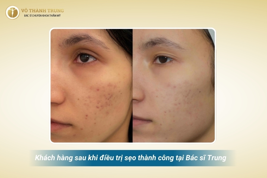 Kết quả thấy rõ trên da khách hàng sau lần đầu thực hiện Kết quả thấy rõ trên da khách hàng sau lần đầu thực hiện