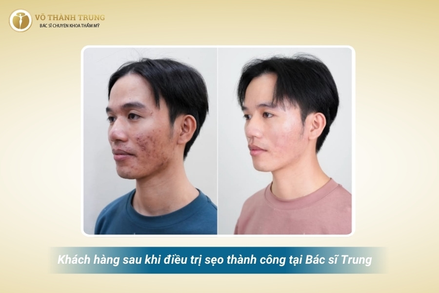 Hai tháng sau thực hiện, tỷ lệ sẹo đã giảm 80% Hai tháng sau thực hiện, tỷ lệ sẹo đã giảm 80%