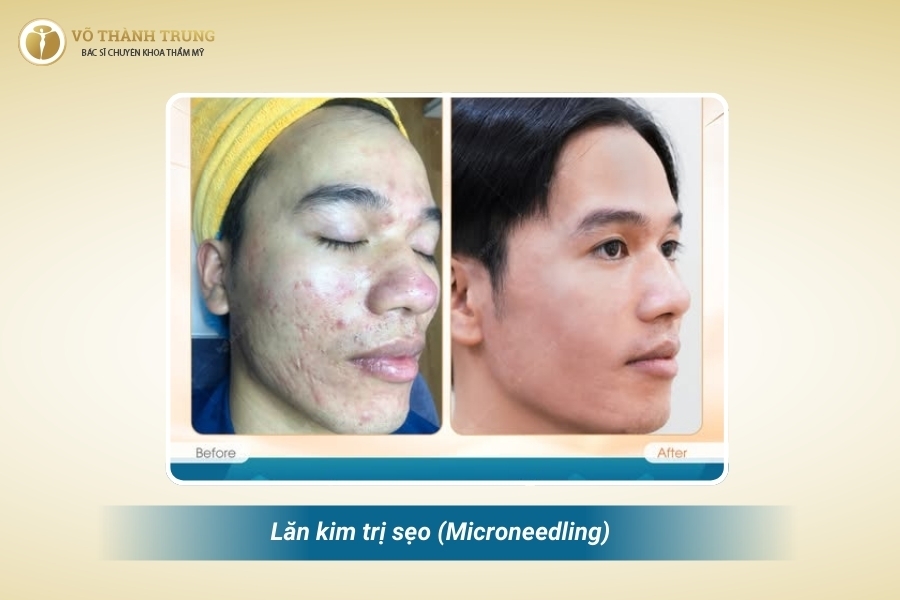 Lăn kim ít xâm lấn và phục hồi nhanh Lăn kim ít xâm lấn và phục hồi nhanh