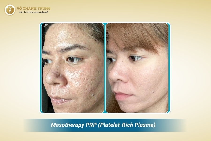 Mesotherapy PRP dùng màu tự thân nên hạn chế nguy cơ kích ứng Mesotherapy PRP dùng màu tự thân nên hạn chế nguy cơ kích ứng