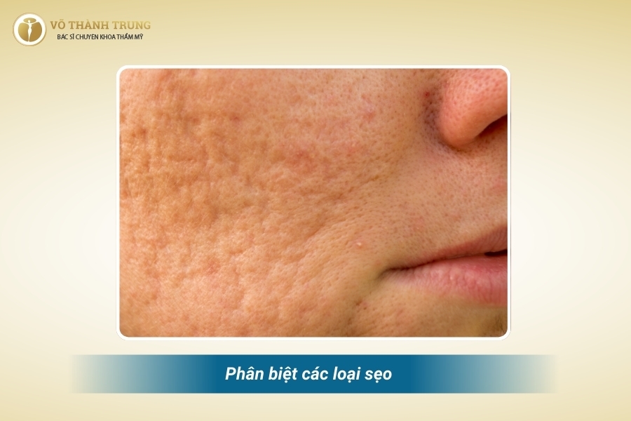 Sẹo lồi và sẹo lõm là 2 dạng sẹo phổ biến nhất Sẹo lồi và sẹo lõm là 2 dạng sẹo phổ biến nhất