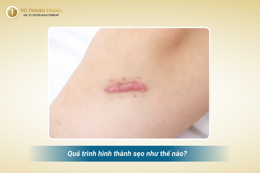Sẹo hình thành sau khi da bị tổn thương, qua 4 giai đoạn Sẹo hình thành sau khi da bị tổn thương, qua 4 giai đoạn
