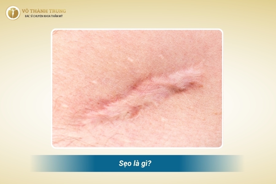 Sẹo là lớp da do collagen hình thành quá mức Sẹo là lớp da do collagen hình thành quá mức