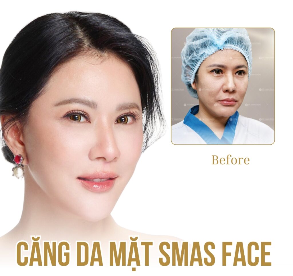 hình ảnh trước sau căng da mặt bác sĩ vothanhtrung