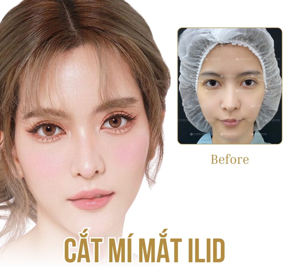 hình ảnh trước sau cắt mí mắt vothanhtrung