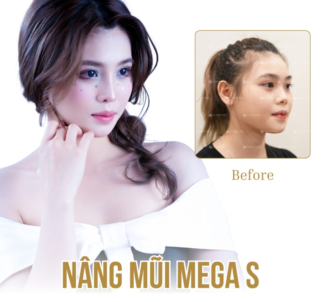 hình ảnh trước sau nâng mũi bác sĩ vothanhtrung