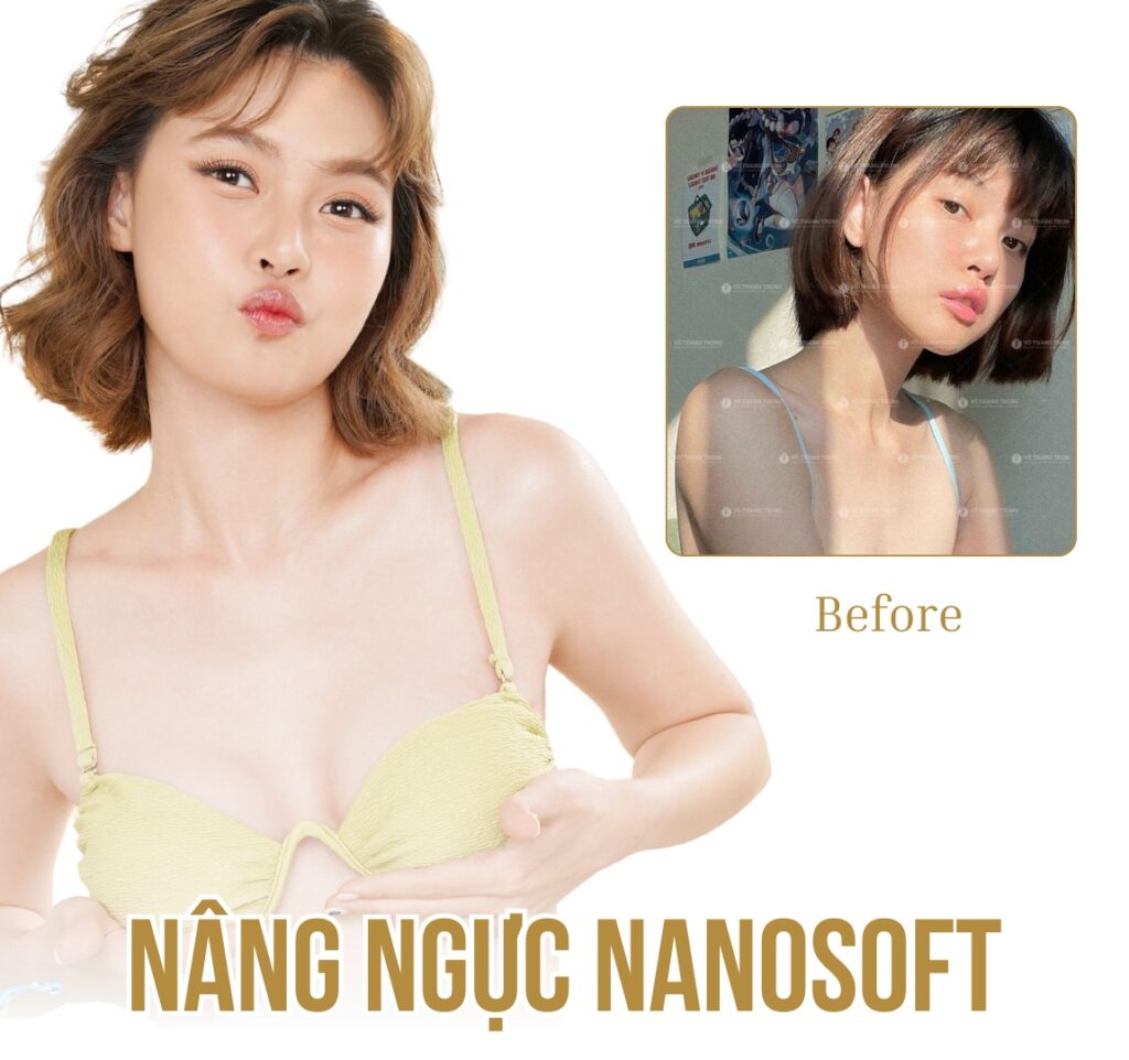 hình ảnh trước sau nâng ngực vothanhtrung