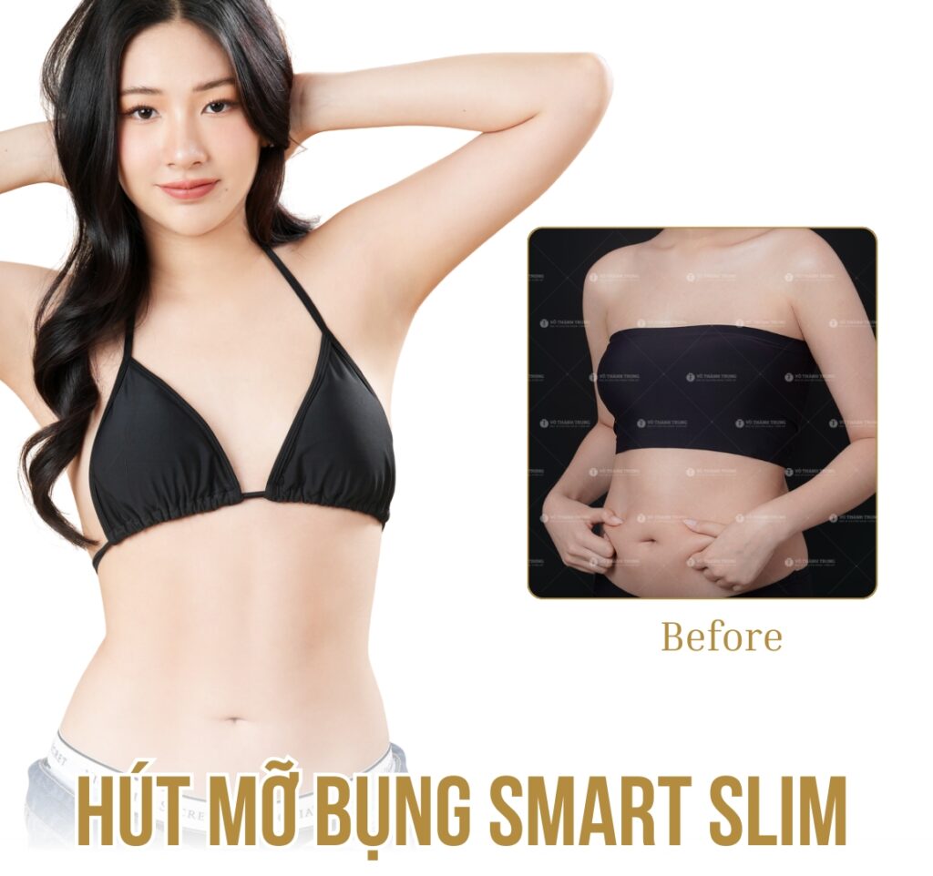 hút mỡ bụng trước sau tại bác sĩ vothanhtrung