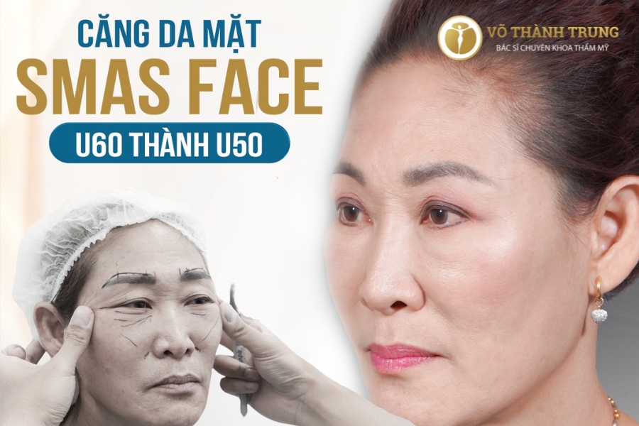 Căng da mặt SMAS FACE – Bí thuật hồi xuân của quý cô U60