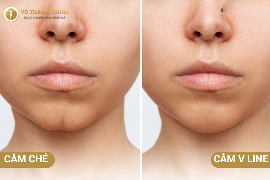 Cằm chẻ là sao? Đây là đặc điểm khuông mặt đặc trưng bởi vết lõm nằm ở giữa cằm