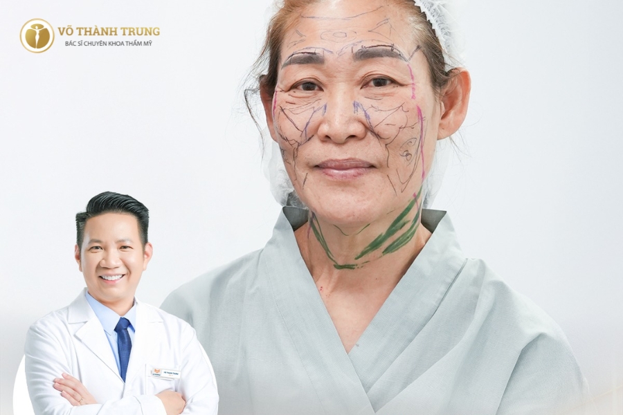 câu chuyện khách hàng căng da mặt chị hạnh