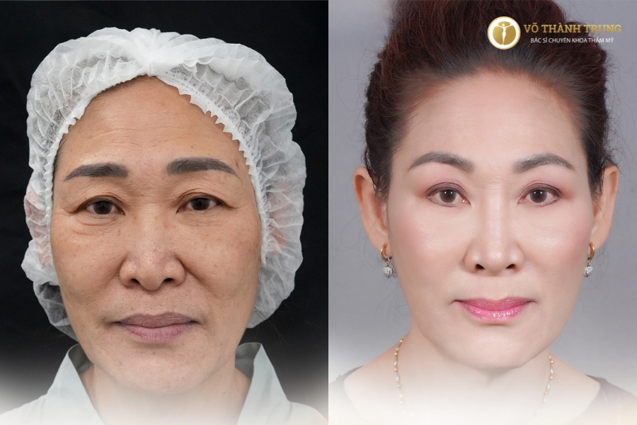 Hình ảnh chị Hạnh trước và sau khi căng da mặt SMAS FACE tại Bác sĩ Trung
