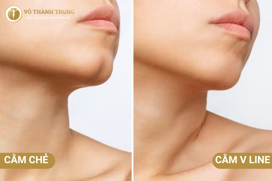Bạn có thể phẫu thuật tạo cằm chẻ để tạo điểm nhấn cho khuôn mặt